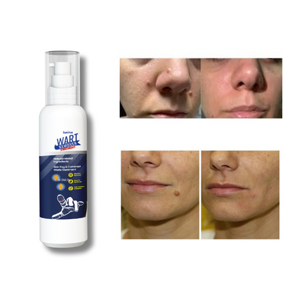 Removedor de verrugas- WART REMOVER 30 ml